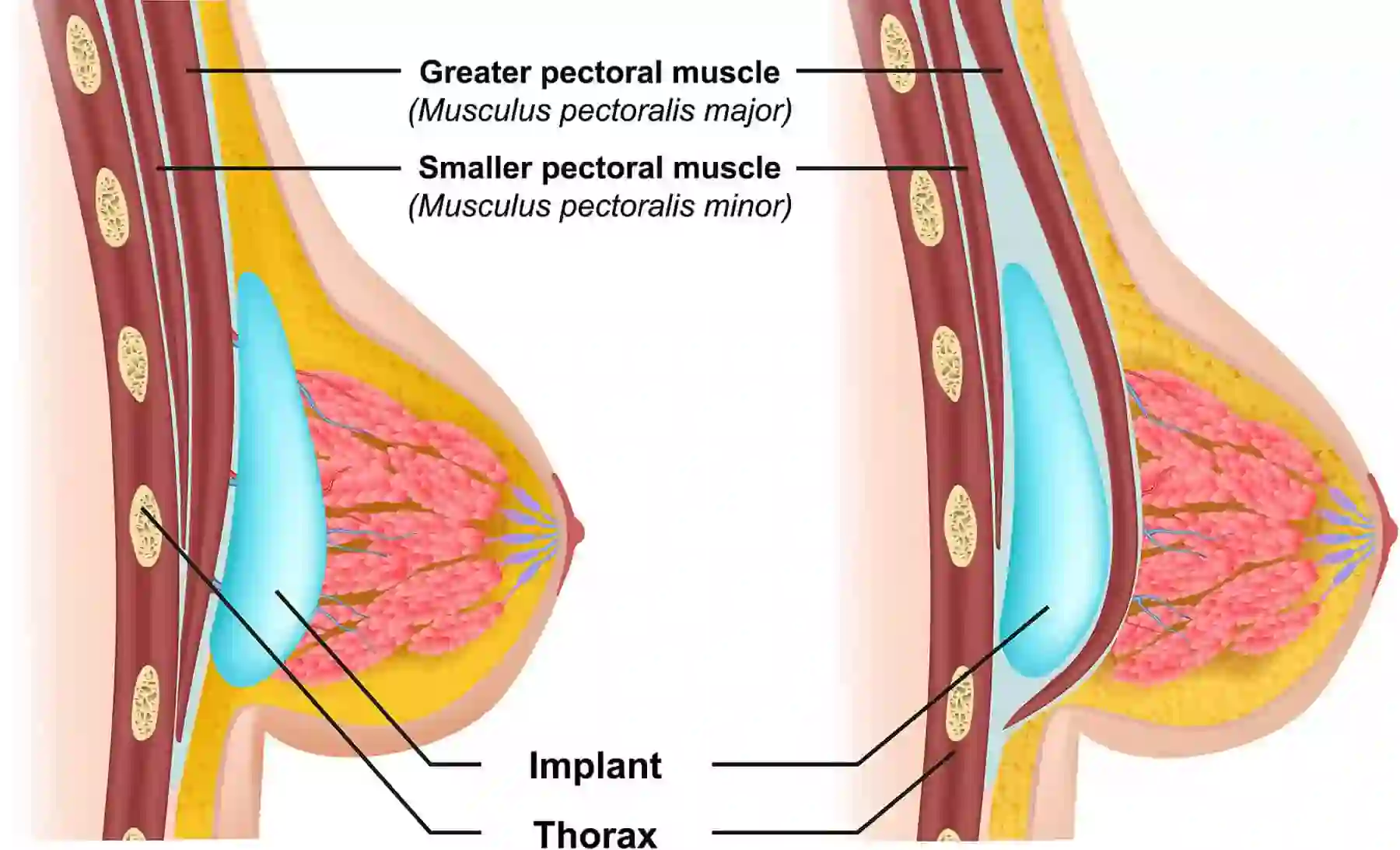 Breast Augmentation Capsular Contracture