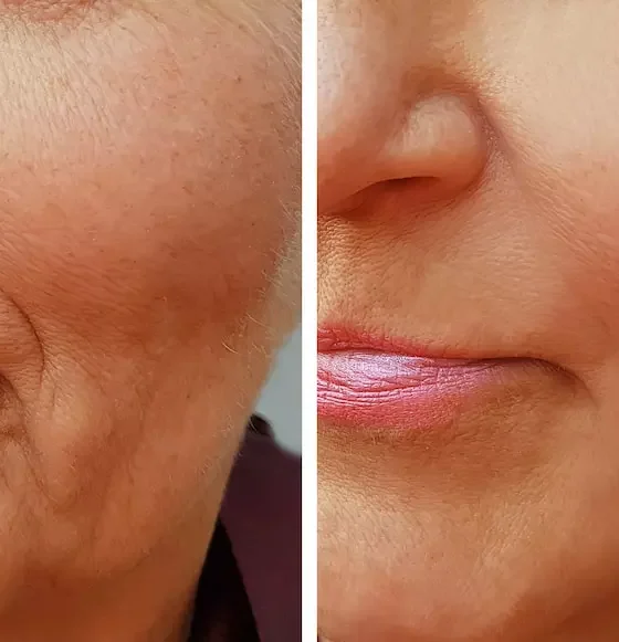Wrinkle Fillers