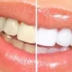 Teeth Whitening for Sensitive Teeth Options in West Hollywood