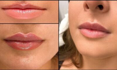Thin Lips