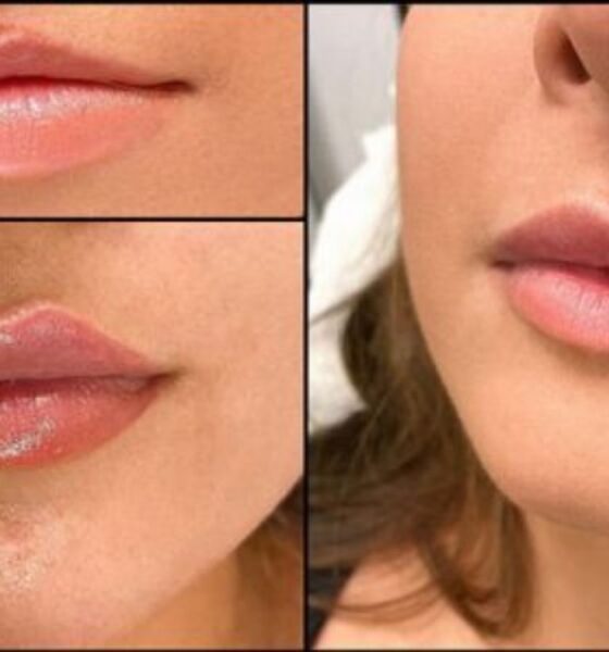 Thin Lips