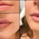 Thin Lips