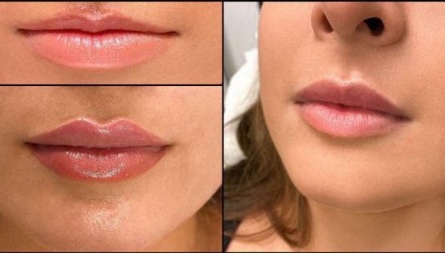Thin Lips