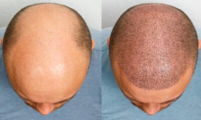 Common Myths and Facts About Hair Transplants