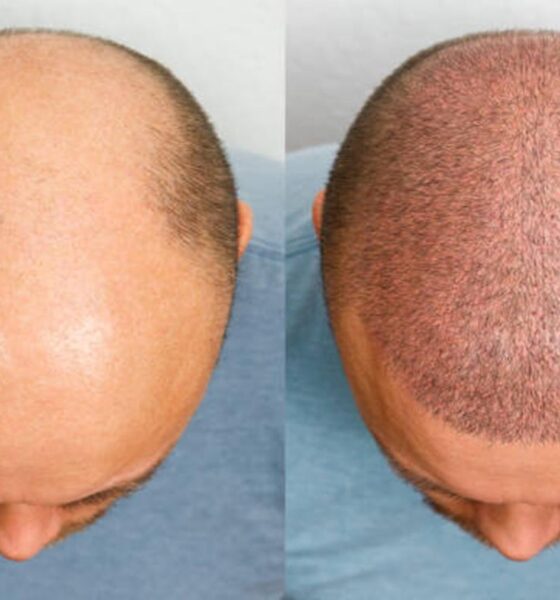 Common Myths and Facts About Hair Transplants