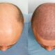Common Myths and Facts About Hair Transplants