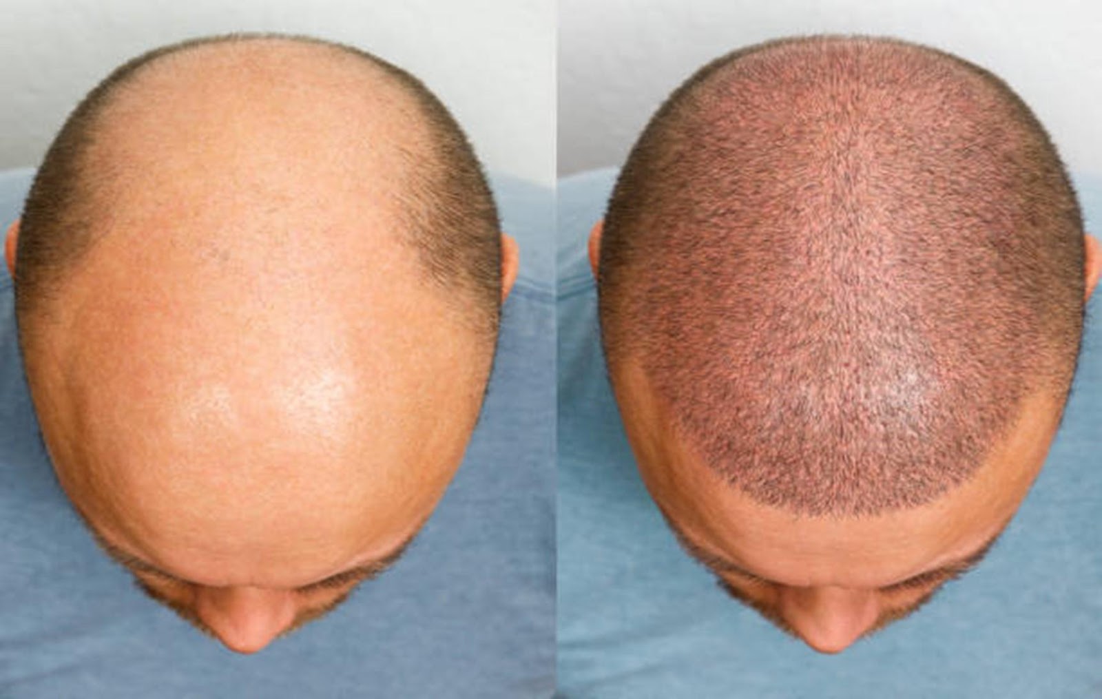 Common Myths and Facts About Hair Transplants