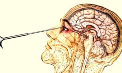 When Were Lobotomies Made Illegal? A Deep Dive Into History, Science, and Ethics